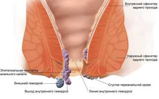 Как проводится лечение тромбоза геморроидального узла?