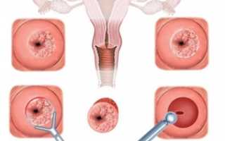 Особенности лечения атипизации при псевдоэрозии шейки матки
