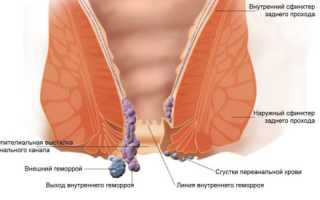 Как использовать гомеопатические свечи от геморроя