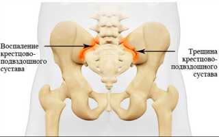 Сакроилеит: симптомы, лечение и прогноз