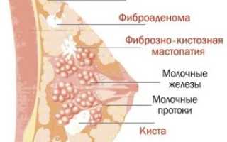 Способы лечения фиброзно-кистозной мастопатии у женщин