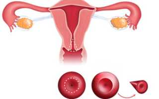 Конизация шейки матки, последствия и восстановление