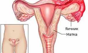 Симптомы и лечение воспаления придатков у женщин