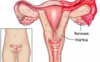 Симптомы и лечение воспаления придатков у женщин