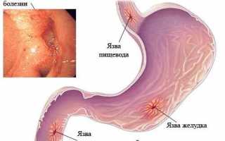 Алкоголь и язва желудка: разрешено ли спиртное при язвенной болезни
