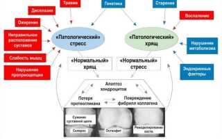 Что это такое артроз и как лечить пораженные суставы