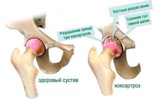 Особенности 2 степени коксартроза тазобедренного сустава