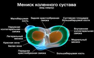 Опасная болезнь менископатия — чем грозит несвоевременное лечение 