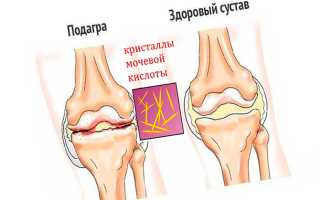 Причины ноющей боли в коленном суставе — методы лечения