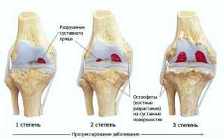 Как лечить артроз коленного сустава