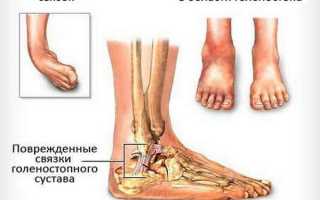 Растяжение связок голеностопа: лечение