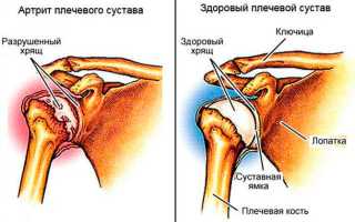 Артрит плечевого сустава: симптомы и лечение