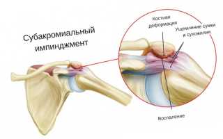 Основные причины развития импиджмент-синдрома плечевого сустава — методы лечения
