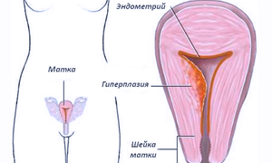 Лечение гиперплазии эндометрия матки различных видов