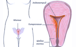 Лечение гиперплазии эндометрия матки различных видов