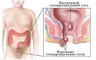 Каковы причины и признаки геморроя у женщин?