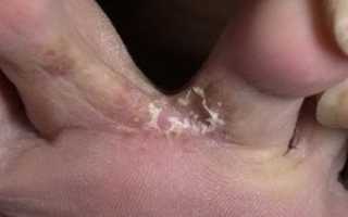 Преет кожа между пальцами ног и запах