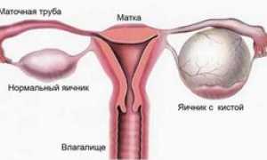 Лечение кисты яичника народными средствами