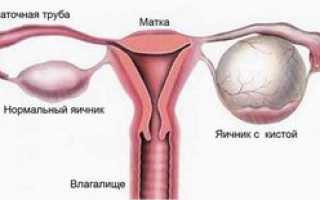 Лечение кисты яичника народными средствами