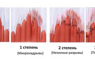 Растяжение мышц ноги — чем грозит не лечение болезни