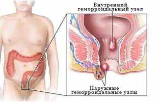 Как выглядит наружный и внутренний геморрой?