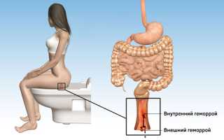 Информация к действию: как вылечить геморрой навсегда