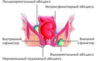 Как возникает парапроктит и его симптомы