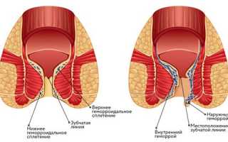 Причины и лечение внутреннего геморроя