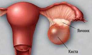 Причины и лечение эндометриоидной кисты яичника