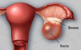 Причины и лечение эндометриоидной кисты яичника