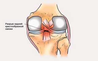 Разрыв задней крестообразной связки — серьезные последствия после травмы