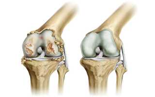 Гонартроз коленного сустава: что это такое, причины и лечение
