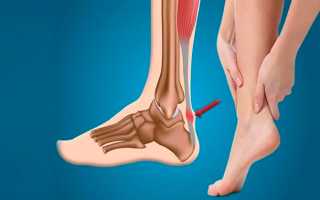 Особенности растяжения ахиллова сухожилия — первая помощь при травме