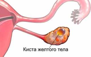 Киста жёлтого тела: причины, симптомы, лечение