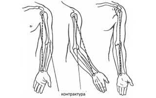 Какими бывают контрактуры — все, что необходимо знать о болезни
