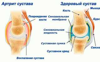 Лечение артрита народными средствами в домашних условиях