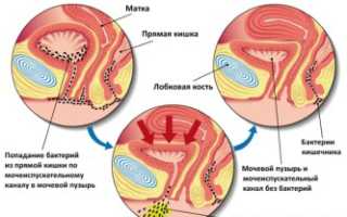 Как просто, но действенно предотвратить цистит?