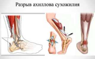 Разрыв ахиллова сухожилия — первая помощь пострадавшему