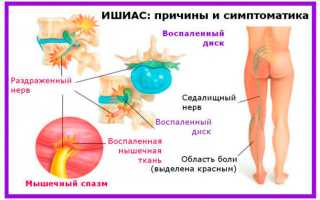 Почему боль в спине отдает в ногу и как избавиться от болевого синдрома