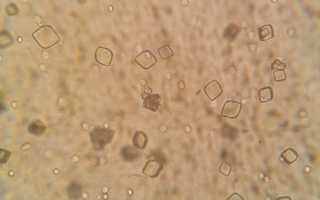 Соли-кристаллы трипельфосфатов-струвитов в моче детей, взрослых