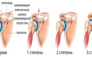 Растяжение связок плеча — чем грозит не лечение болезни