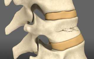 Компрессионный перелом позвоночника