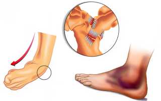 Основные причины вывиха голеностопного сустава: лечение травмы и последствия