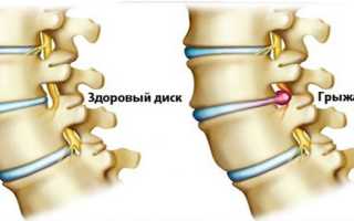 Лечение грыжи позвоночника: надежные методы
