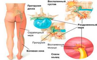 Причины появления вертеброгенной люмбалгии — упражнения для восстановления