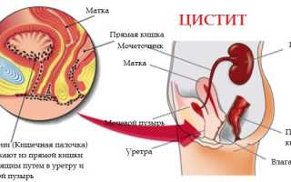 Как связаны цистит и алкоголь и можно ли употреблять спиртное при заболевании?