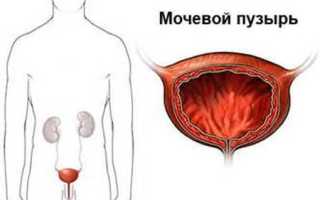 Принципы лечения воспаления мочевого пузыря у мужчин