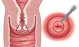 Биопсия шейки матки: подготовка к процедуре, метод проведения