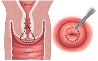 Биопсия шейки матки: подготовка к процедуре, метод проведения