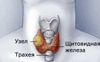 Диагноз узловой зоб: симптомы заболевания щитовидной железы
